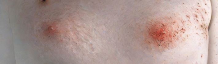 Why Your Clothes Might Be Causing That Mysterious Rash